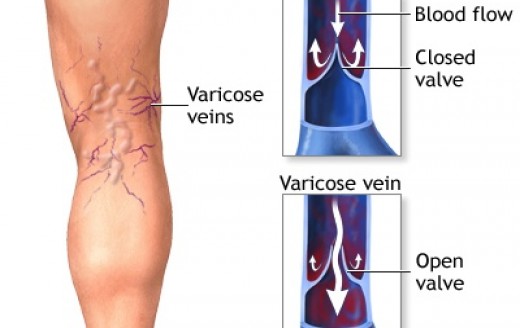 varicosevein