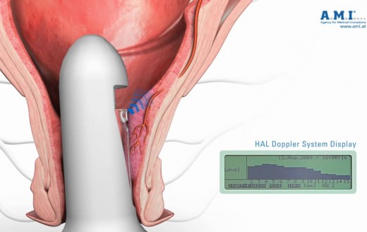 HAEMORRHOIDAL ARTERY LIGATION